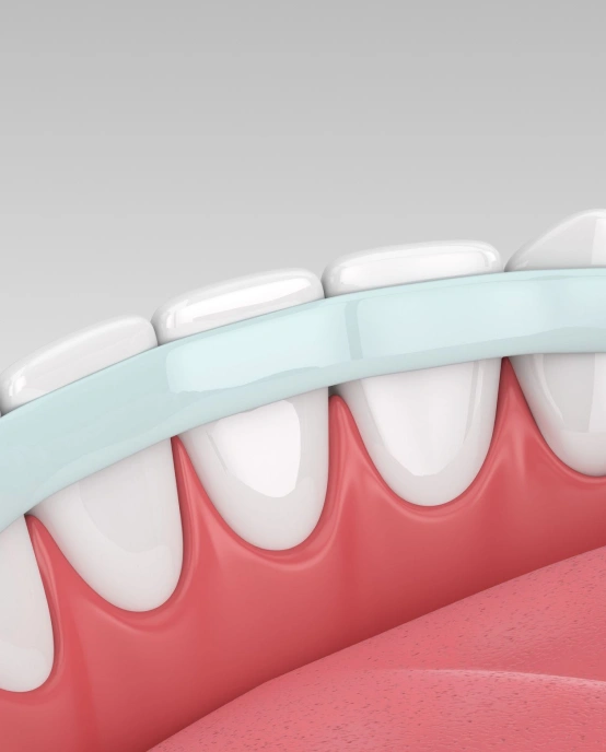 Dental bonding on teeth with composite resin.