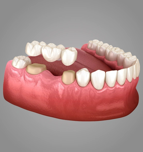 Dental Bridge Replacing Missing Teeth
