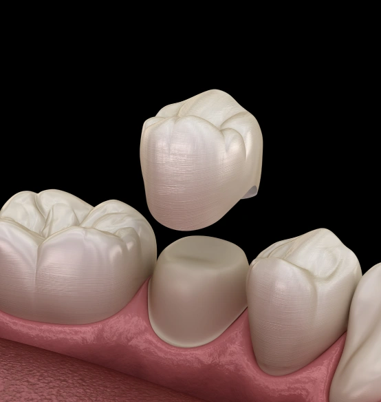 Dental Crown Used to Repair and Protect a Damaged Tooth
