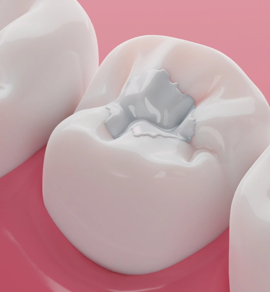 Dental Filling Used to Repair Tooth Decay and Cavities