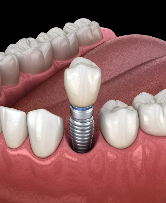 Dental implant replacing a missing tooth.