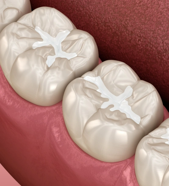 Dental Sealant Treatment Helping Protect Teeth From Cavities and Decay