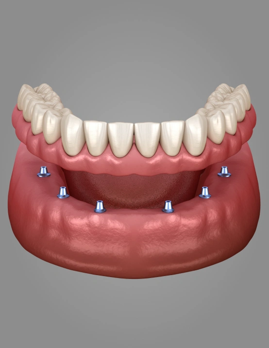 Full Mouth Dental Reconstruction Improving Oral Health and Function