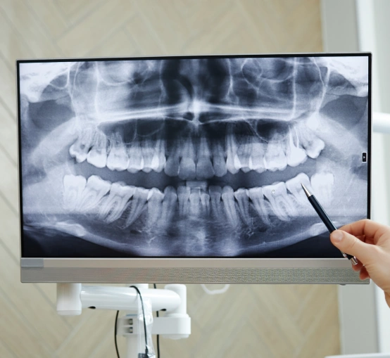 Panoramic X-Rays for Complete Smile Imaging